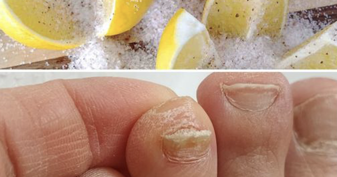 Discover the Power of Lemon and Salt in Tackling Toenail Fungus