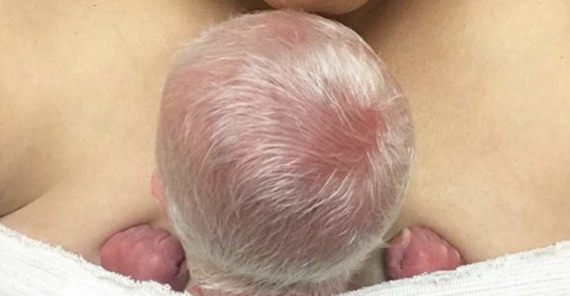 Baby Mocked for Having White Hair – Now Flourishing