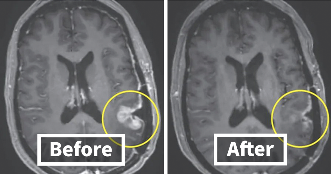 Glioblastoma Patient Sees Tumor Almost Disappear In Days Thanks To New Breakthrough