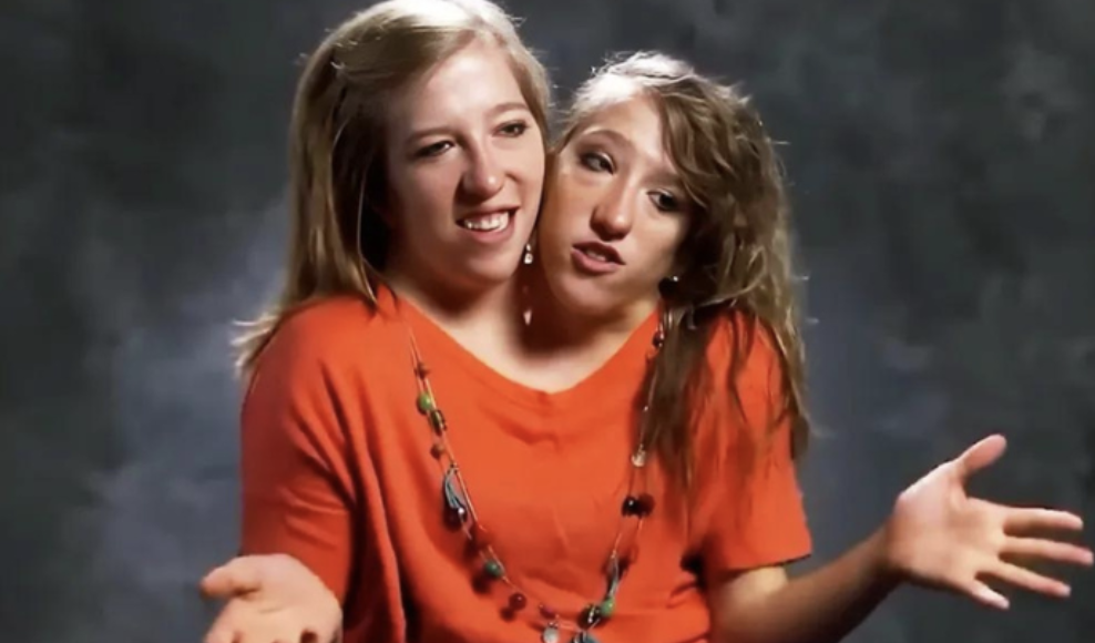 Conjoined Twin Abby Hensel Secretly Ties the Knot: People’s Concerns About Brittany