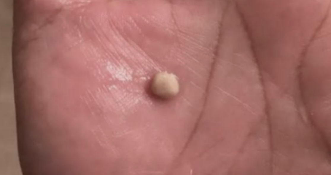 There’s Something Satisfying About Watching Tonsil Stone Removal Videos