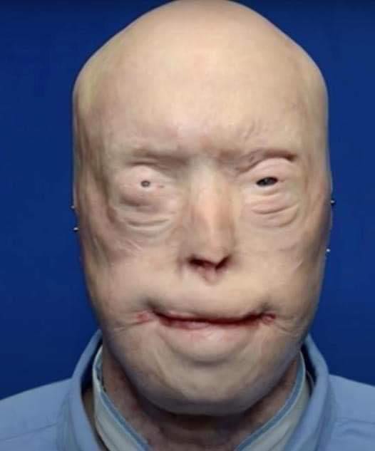 Patrick Hardison’s Transformation: A Face Transplant Journey