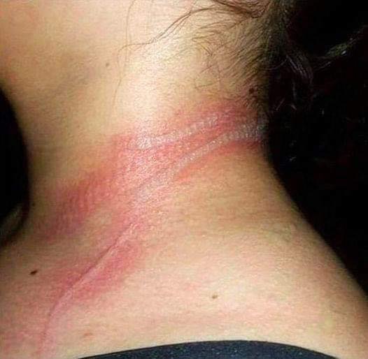 The child, only 13 years old, had terrible marks on her neck