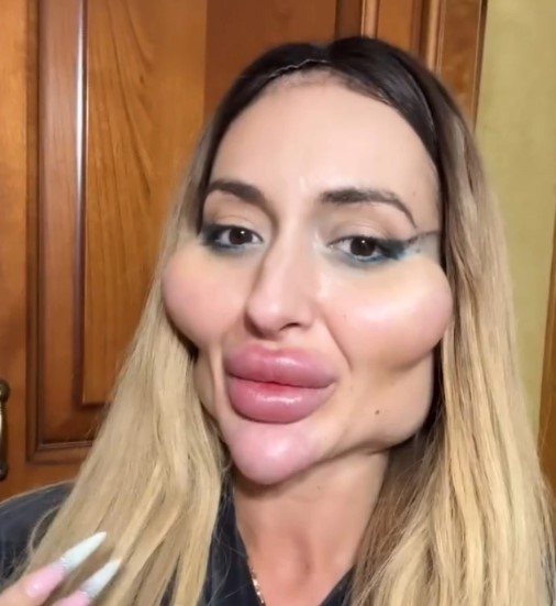 She Got Multiple Surgeries To Have “The World’s Biggest Cheeks”: What Does The Girl Look Like Before All The Cosmetic Interventions?