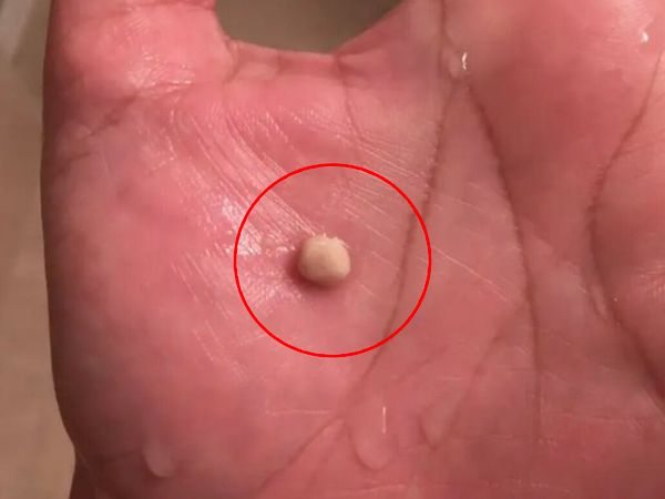 Everything You Need to Know About Tonsil Stones, the Weird Growths That Look Like Pimples in Your Throat