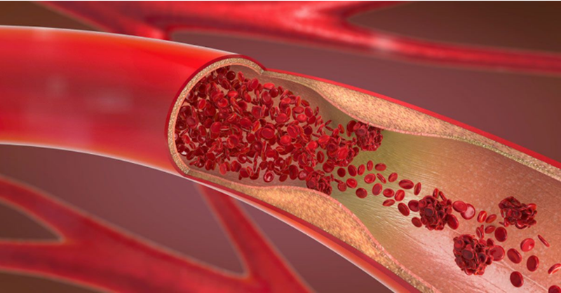 8 Ways to Fight Cholesterol and High Blood Pressure