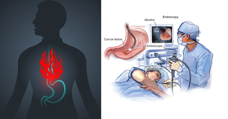 The Silent Menace: Why You Shouldn’t Ignore Persistent Heartburn