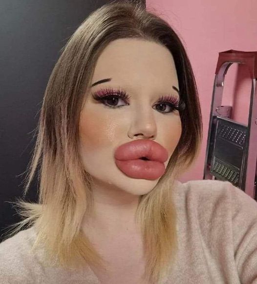 24-year-old woman with ‘biggest lips’ in the world has spent $5,000 on fillers and still wants to go BIGGER