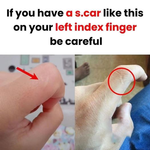 Be Careful If You Notice This Scar on Your Left Index Finger