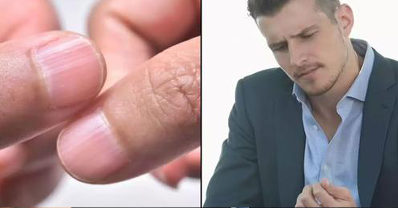 Doctor Reveals 7 Health Conditions You Can Spot Just By Checking Your Nails